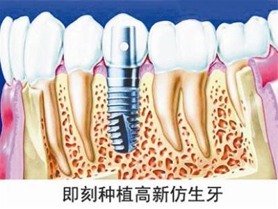 高新仿生牙每颗